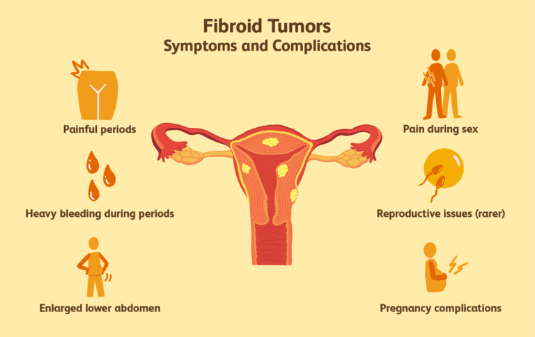 MANAGING FIBROIDS WITHOUT HYSTERECTOMY- What Your Doctor Won’t Tell You!